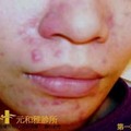 胜肽酸導入-很溫和的換膚導入,敏感性皮膚也可以作的療程,可以改善青春痘