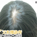 以微針刺激頭皮 促進毛囊生髮 強健毛囊 預防掉髮
