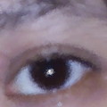 My eye in 2th Dec 2006