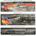 靜脈曲張複合式杜卜勒血管超音波檢查-圖2
