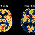 大腦斷層掃描比較照片