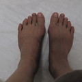 2/25.右腳術後1年2個月,左腳8個月