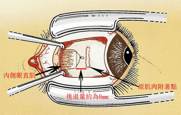 斜視手術- dennislameyecenter 的部落格- udn部落格