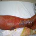 下肢潰瘍合併蜂窩性組織炎