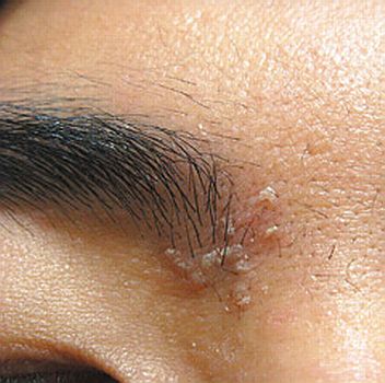 ●脂漏型皮膚炎患者易在眉心，或T字部位形成黃白色皮塊。圖／王致統醫師提供