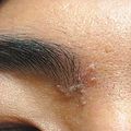脂漏型皮膚炎患者易在眉心，或T字部位形成黃白色皮塊。圖／王致統醫師提供