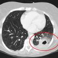 肺炎 CT片1
