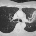 肺炎 CT片2