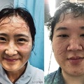 左: 武漢護士  右: 台灣聯合醫院胸腔科主治醫師鄒冠全 長時間戴N95口罩滿臉壓痕