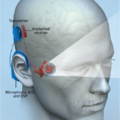 Cochlear Implant_graphic