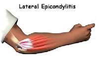 錯誤的瘦身做法最終罹患網球肘