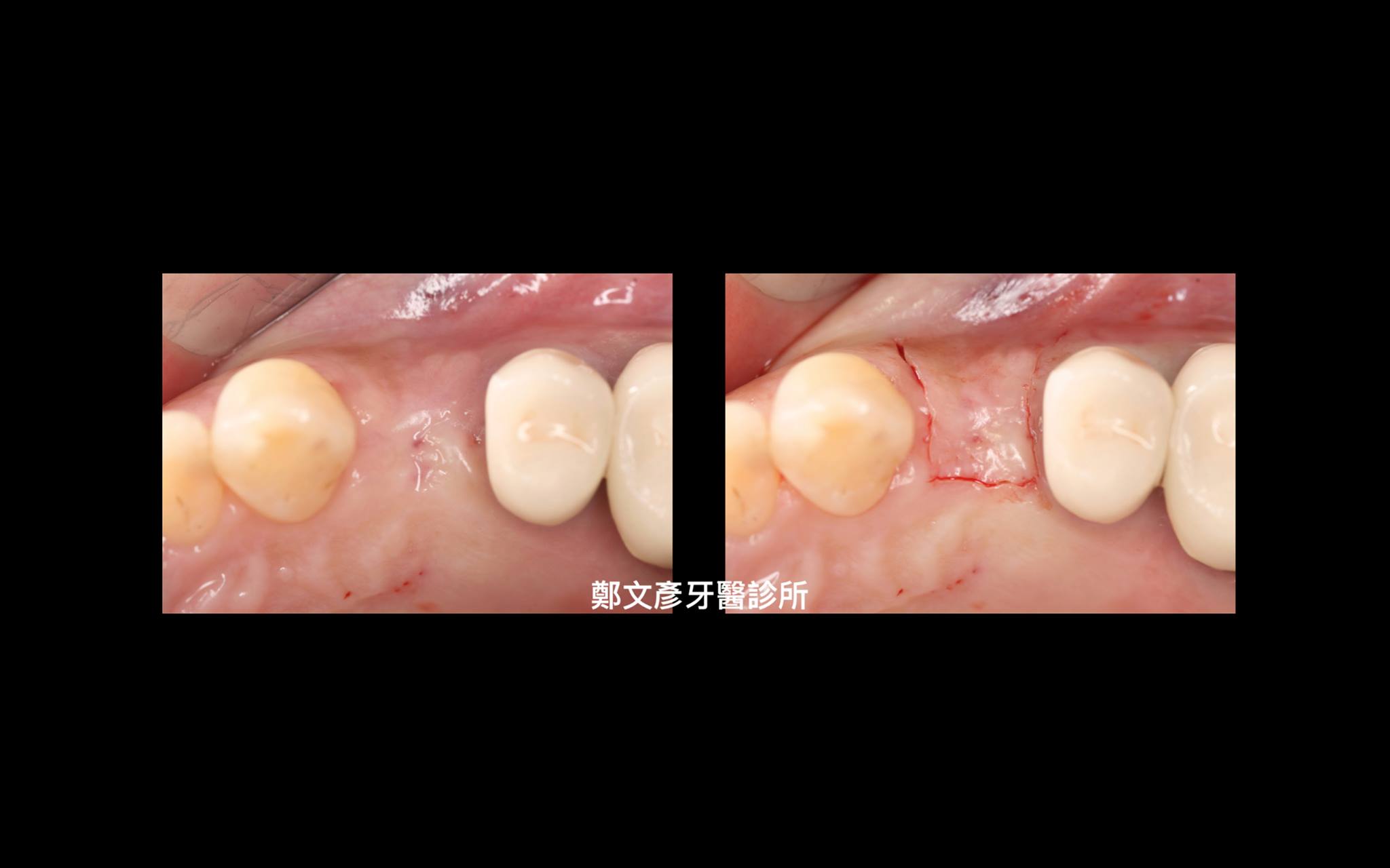 3 Role Of Granulation Tissue In Socket Preservation 鄭文彥牙醫診所的部落格 Udn部落格