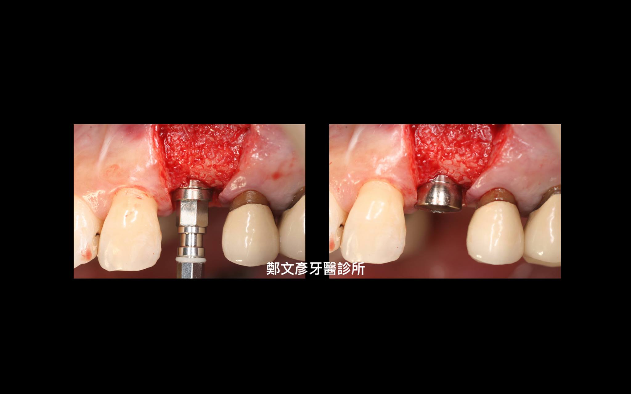 3 Role Of Granulation Tissue In Socket Preservation 鄭文彥牙醫診所的部落格 Udn部落格