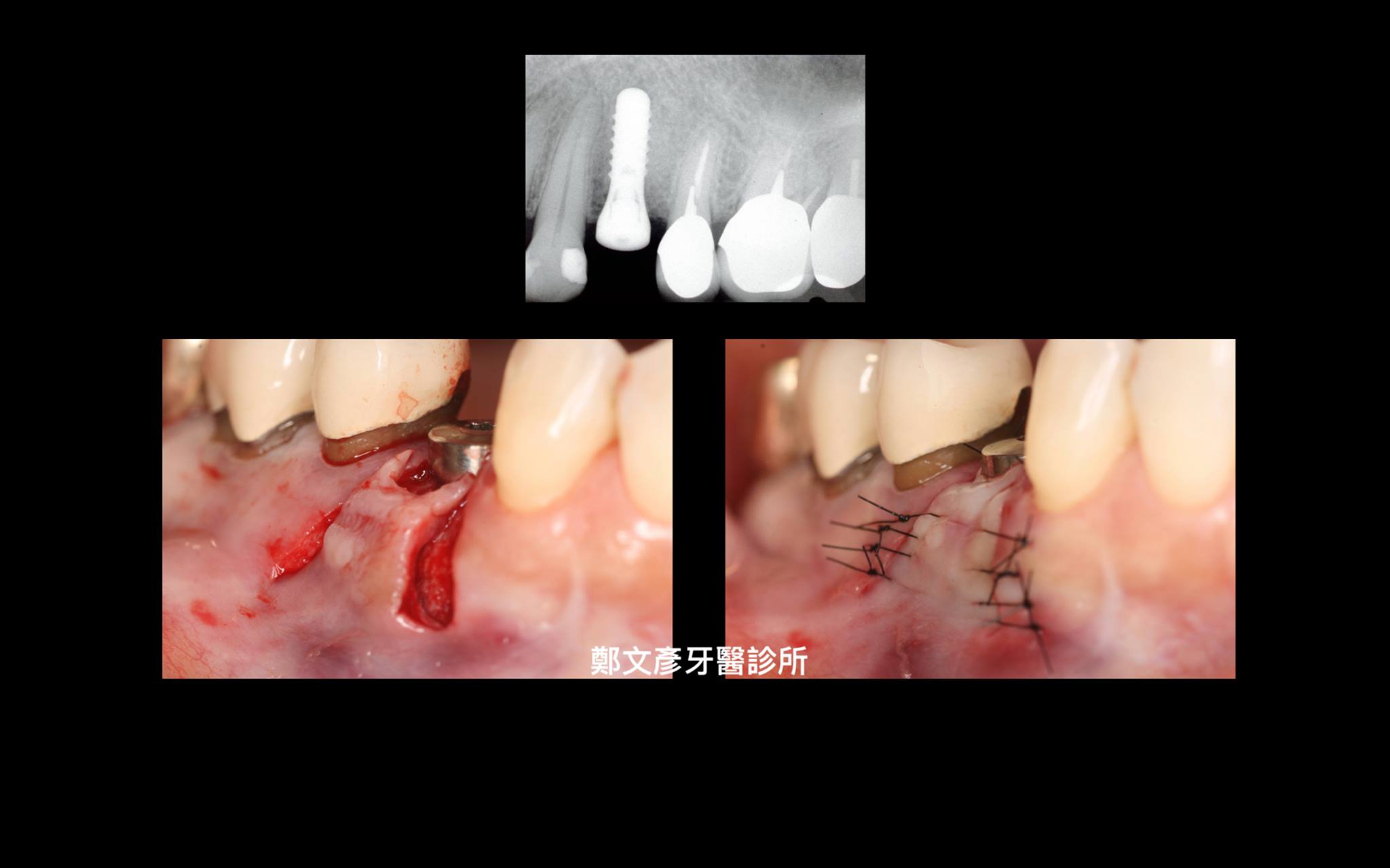 3 Role Of Granulation Tissue In Socket Preservation 鄭文彥牙醫診所的部落格 Udn部落格