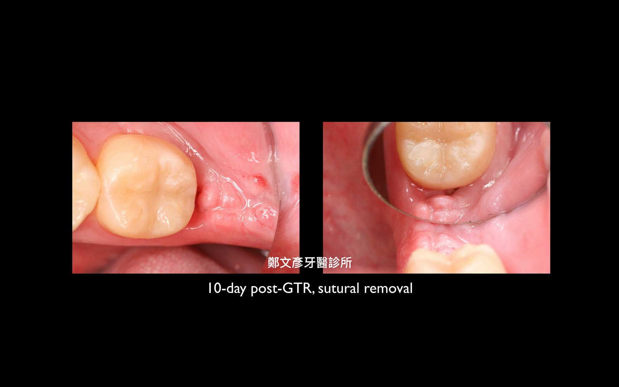 智齒拔除後的齒槽骨缺損修復 Gtr 3 鄭文彥牙醫診所的部落格 Udn部落格