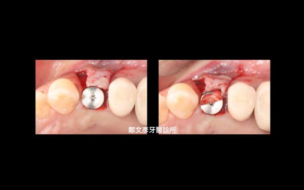 Role Of Granulation Tissue In Socket Preservation 鄭文彥牙醫診所的部落格 Udn部落格