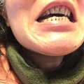 15/1/2021，今天治療的上了保護層膜，牙齒根本看起來比較粗。比較